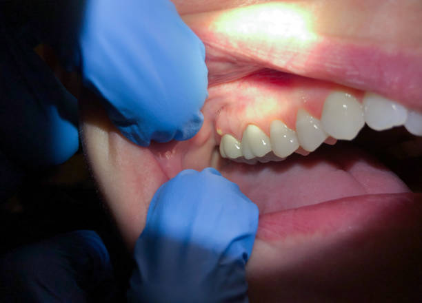Best Emergency Dental Care for Trauma or Injury in West Palm Beach, FL
